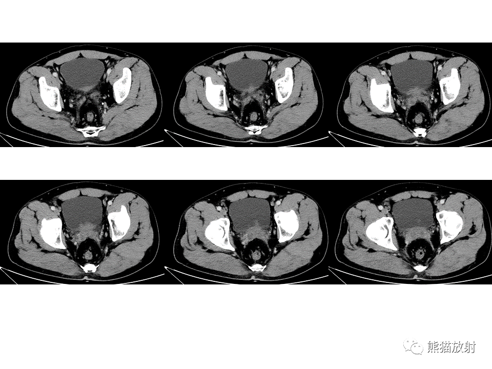 腺性膀胱炎与膀胱尿路上皮癌丨ct鉴别诊断科室交流学习资料内容由研究