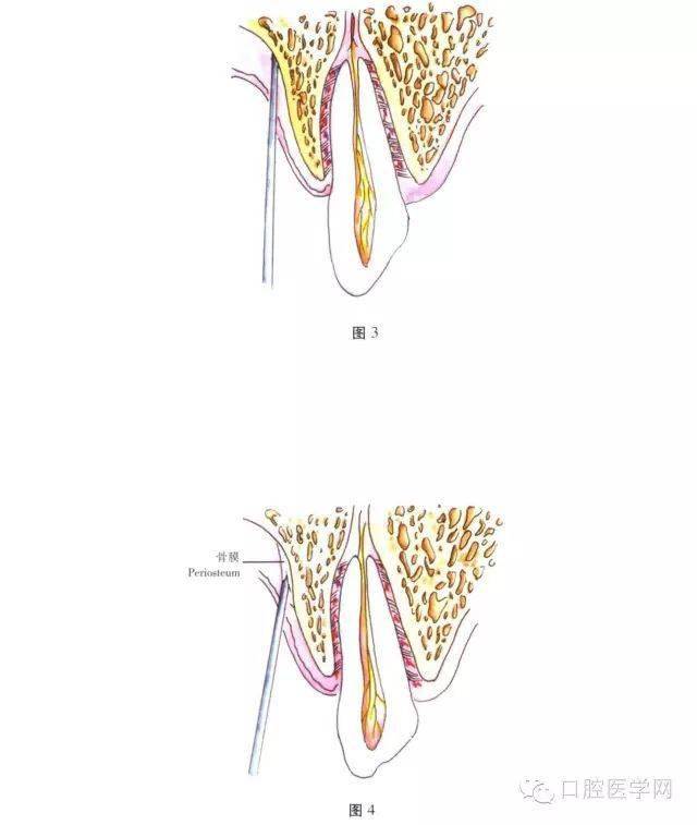 牙周膜麻醉注射方法图片