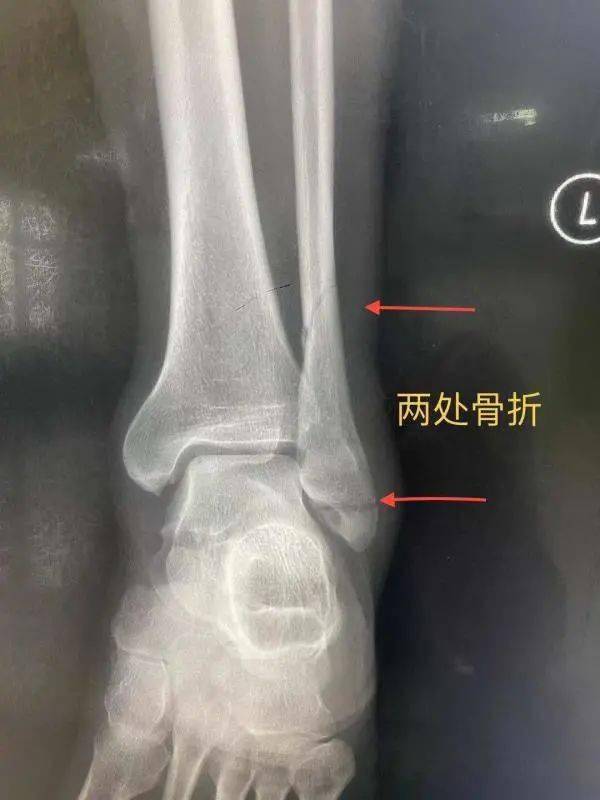 医疗技术小钢针大作用我院这类骨折手术微创即可解决