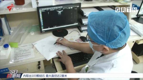 严重|七旬老伯膀胱内取出103颗结石，最大直径近2厘米