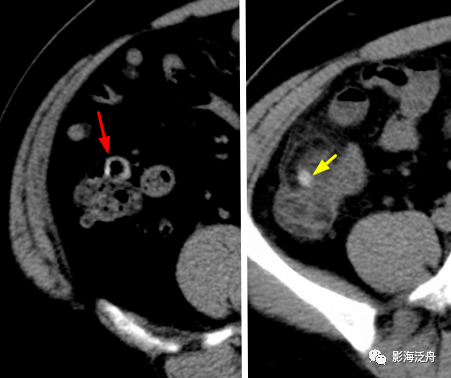 小心误诊,这可不是急性阑尾炎!