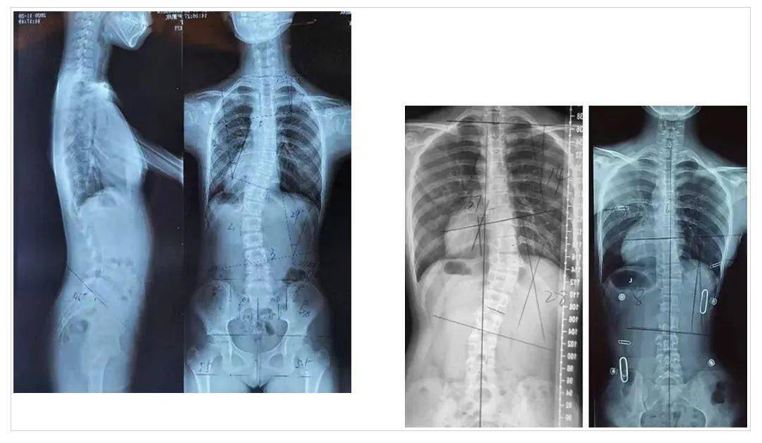孩子错误握笔姿势易致高低肩,仁爱中医专家:警惕脊柱侧弯!