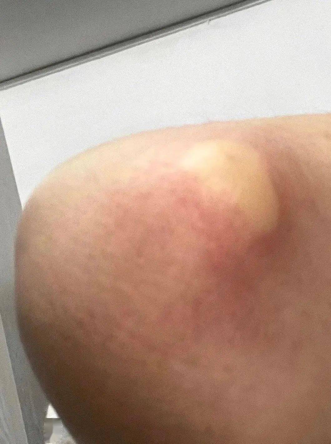 蚊子咬的包能有多离谱