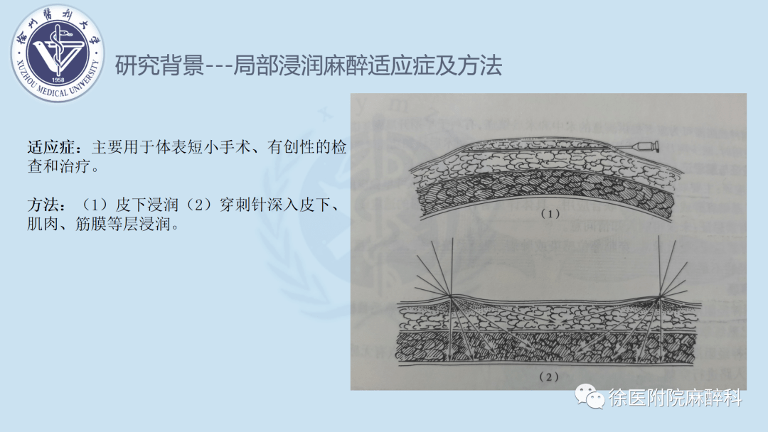 全膝關節置換術中局部浸潤麻醉和連續收肌管阻滯結合ipack神經阻滯的