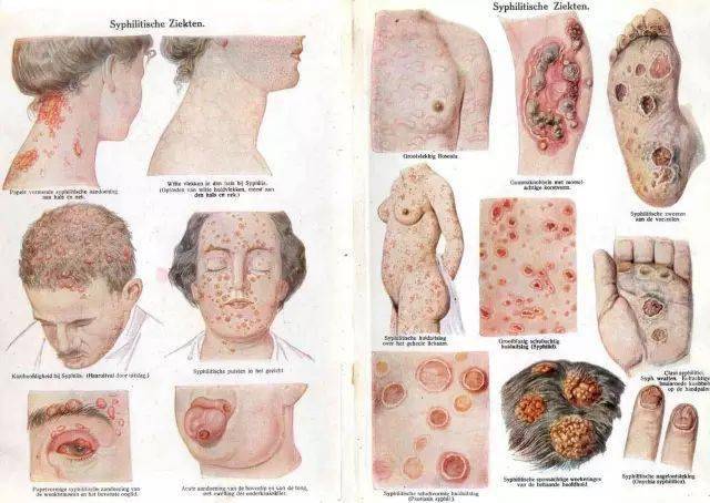 关注 史上最奇葩的性病治疗 水银