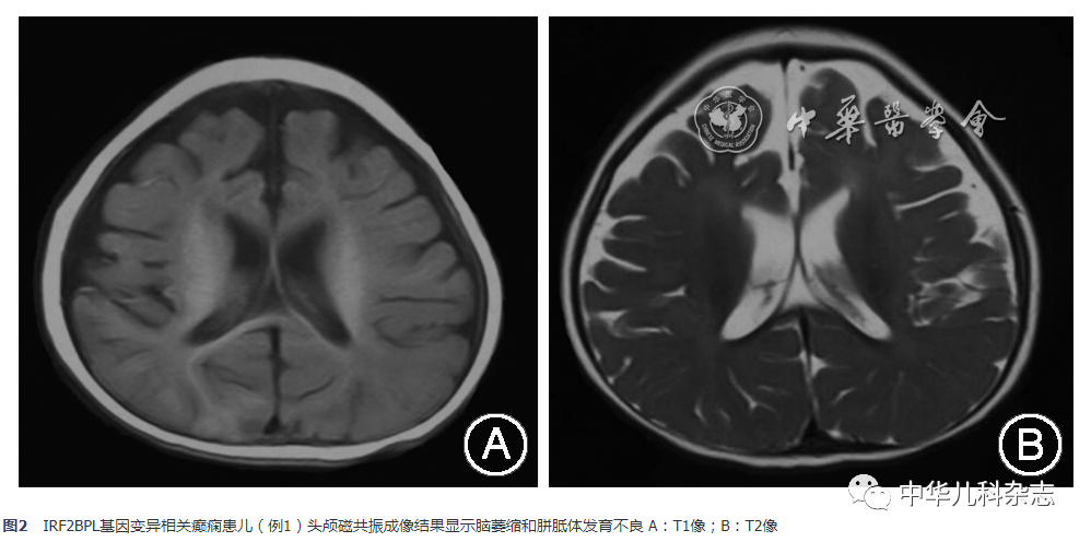 【临床研究与实践】IRF2BPL基因变异相关的癫痫患儿临床表型特点_delG