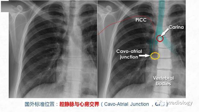 picc胸片定位正常位置图片