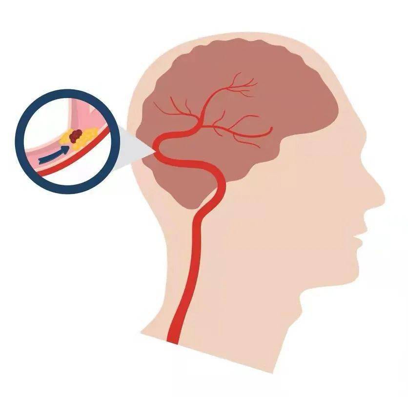 健康内江 | 脑卒中的信号——短暂性脑缺血发作