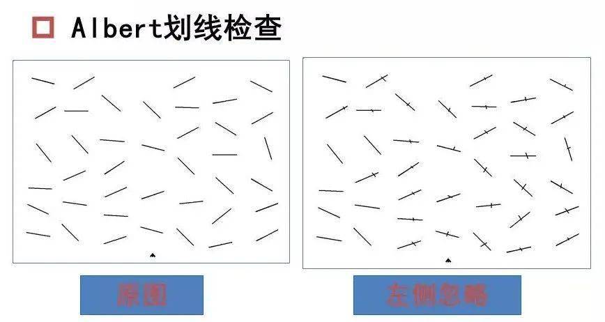 脑卒中后单侧忽略别再忽略另一半