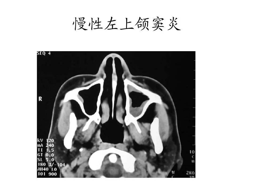 副鼻窦x线解剖图片图片