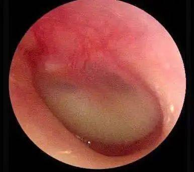 游泳患上中耳炎?注意,这几类人不适合游泳