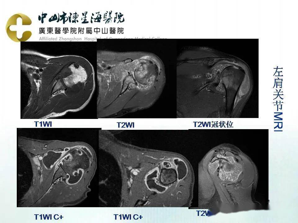 滑膜炎 核磁共振图片