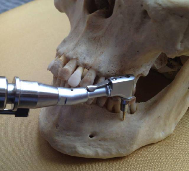 种植体支抗植入位详解