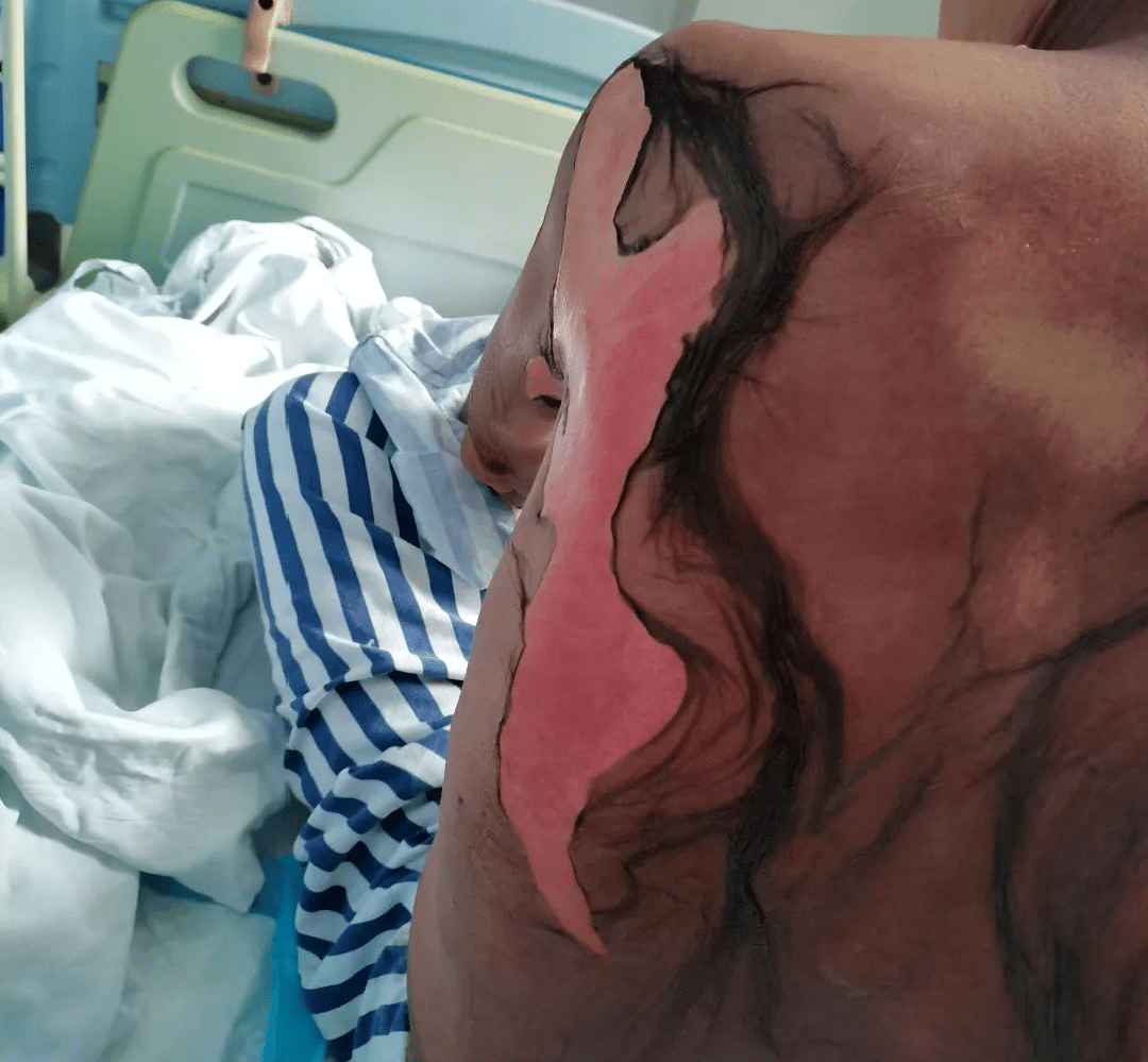 惊惠州一男子这样服药致全身换皮