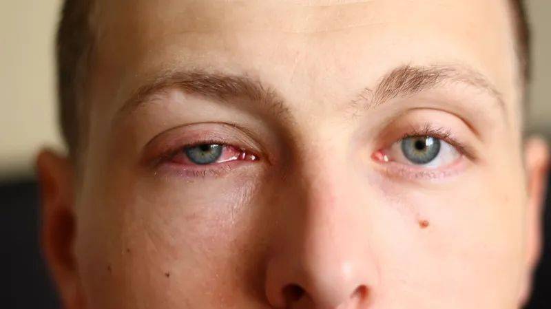 用紫外线灯杀菌小心电光性眼炎