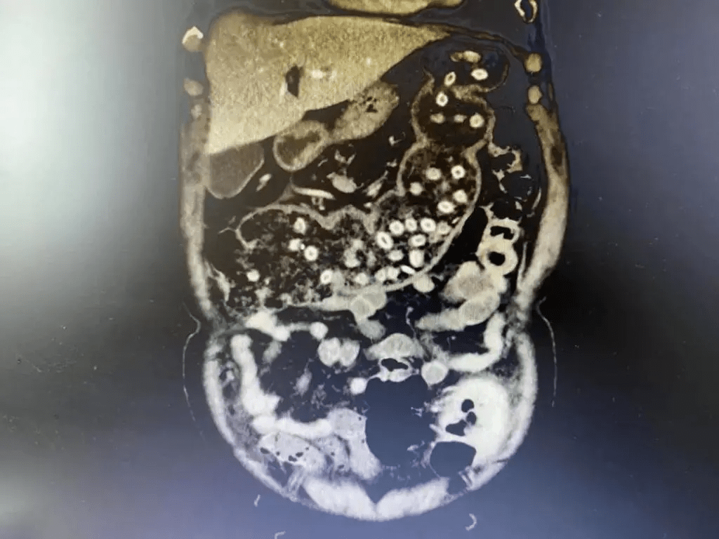 肠梗阻|吃杨梅不吐杨梅核，爷爷肚子塞满杨梅核，快要连成“珍珠项链“