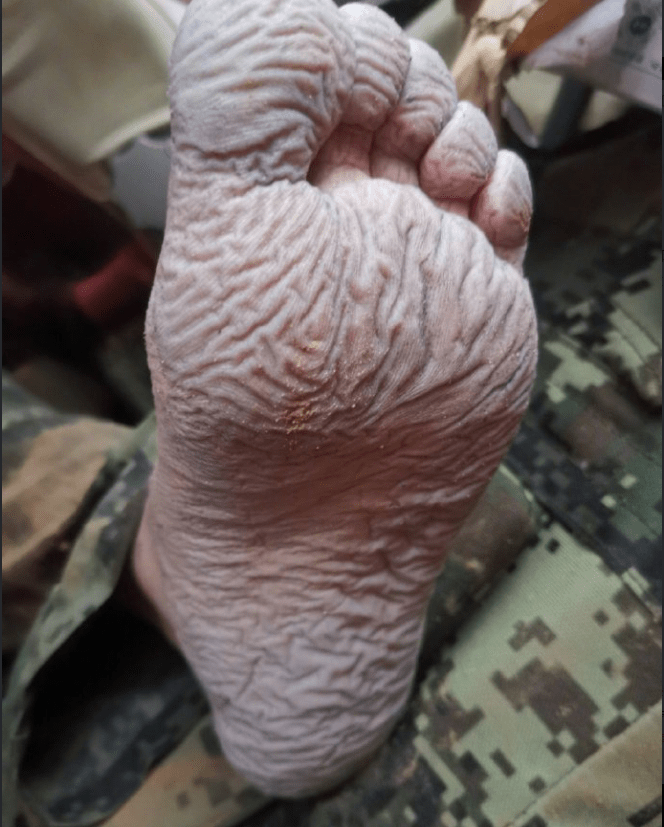 边防战士冻伤的脚图片