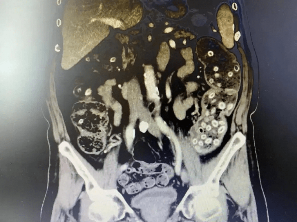 肠梗阻|吃杨梅不吐杨梅核，爷爷肚子塞满杨梅核，快要连成“珍珠项链“