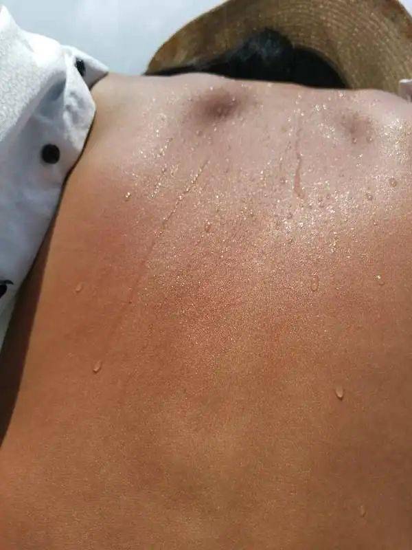 晒背时,不同部位出汗代表什么?