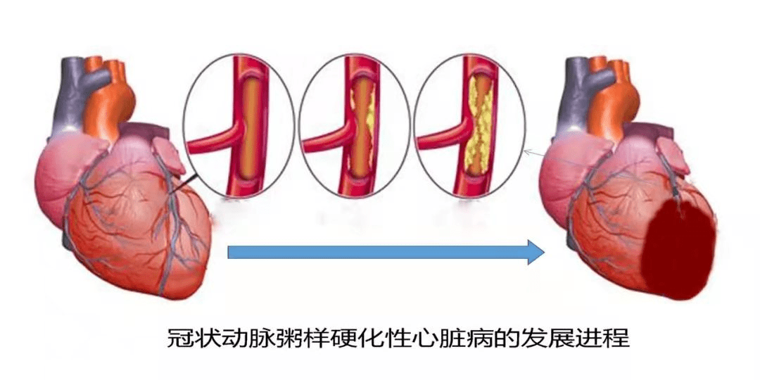 导致的心肌缺血缺氧引起的心脏病