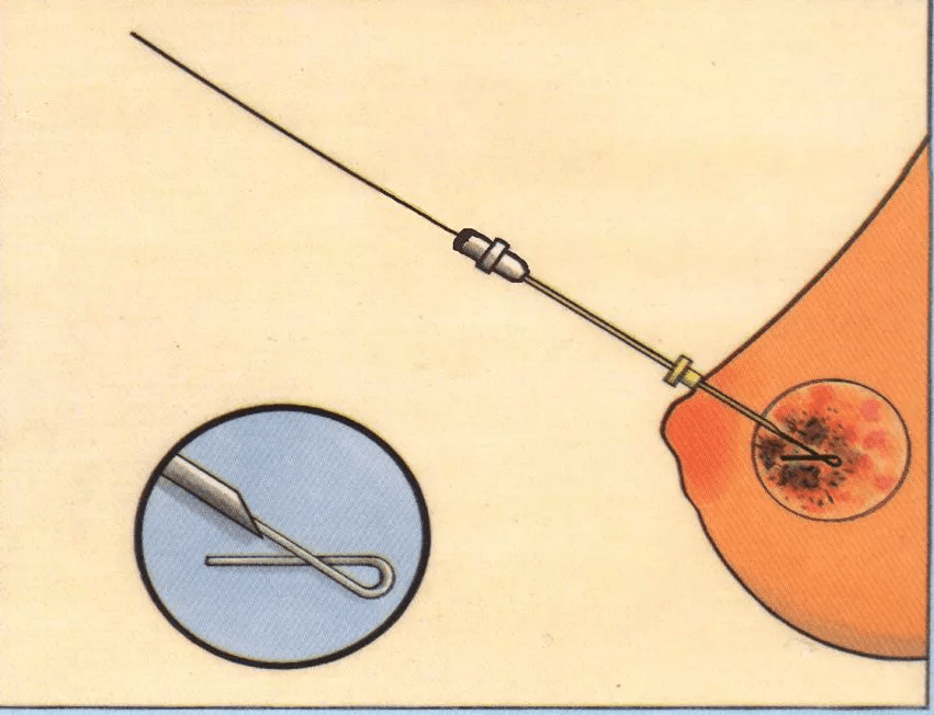 临床触诊摸不到,超声检查难显示,小于2厘米的乳腺可疑病变如何检查?