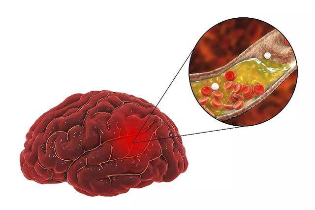 新發現幹細胞治療缺血性腦卒中與這幾大機制密切相關