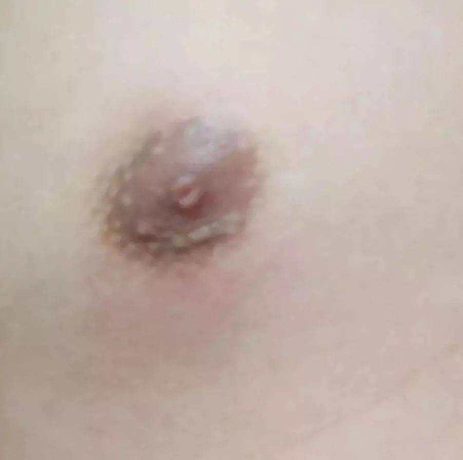 乳腺炎 乳腺增生 乳腺癌等乳房疾病 可不是女性的专利哦 转发给你身边的男性 医生