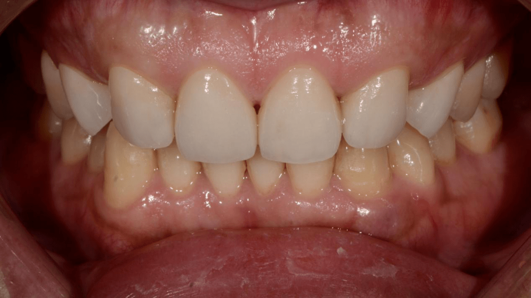 病例前牙烤瓷贴面修复一例