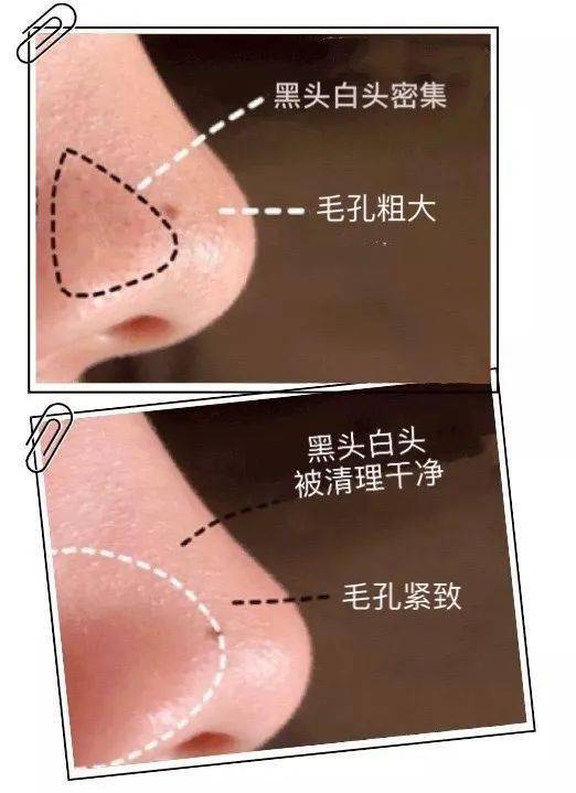 黑头|这张脸，我看了就想吐