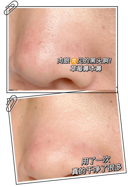 黑头|这张脸，我看了就想吐