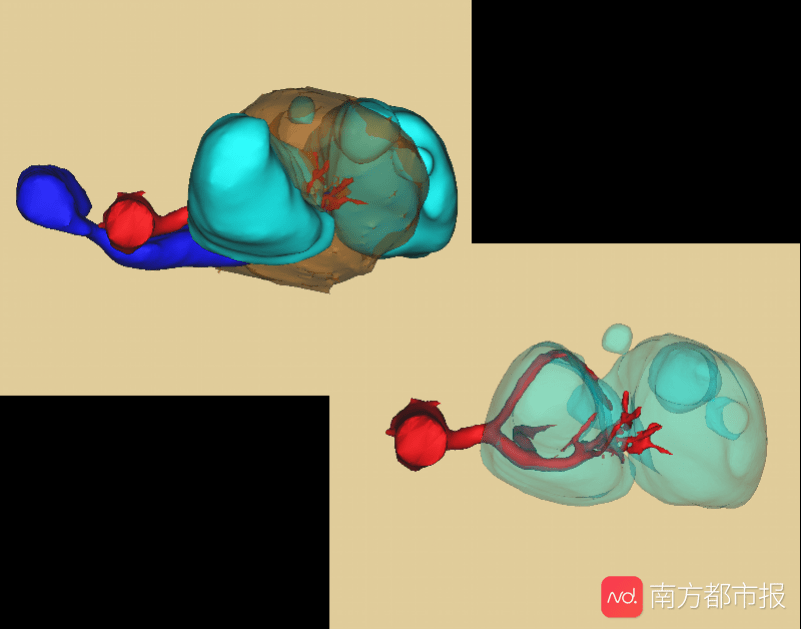 时间|?少女左肾上长两个巨瘤还破裂了，手术机器人成功摘瘤保肾