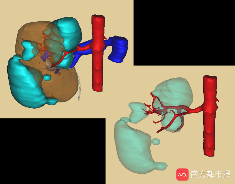 时间|?少女左肾上长两个巨瘤还破裂了，手术机器人成功摘瘤保肾