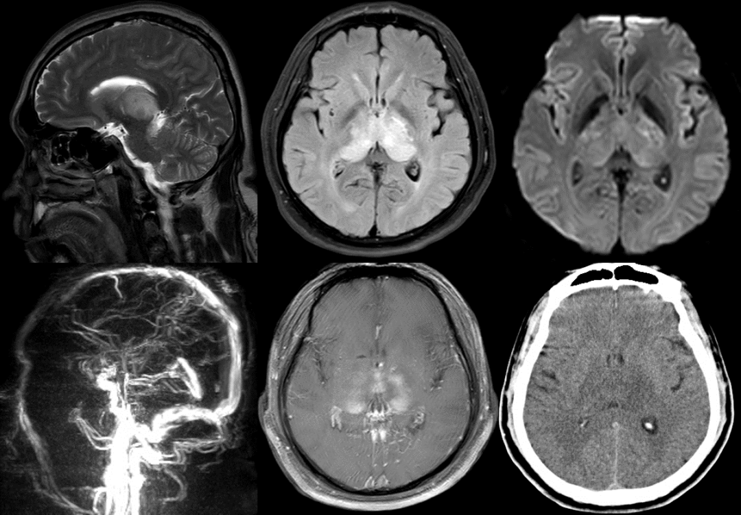 26 神经系统疾病—丘脑病变影像诊断思路