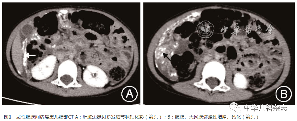 病例报告儿童恶性腹膜间皮瘤一例