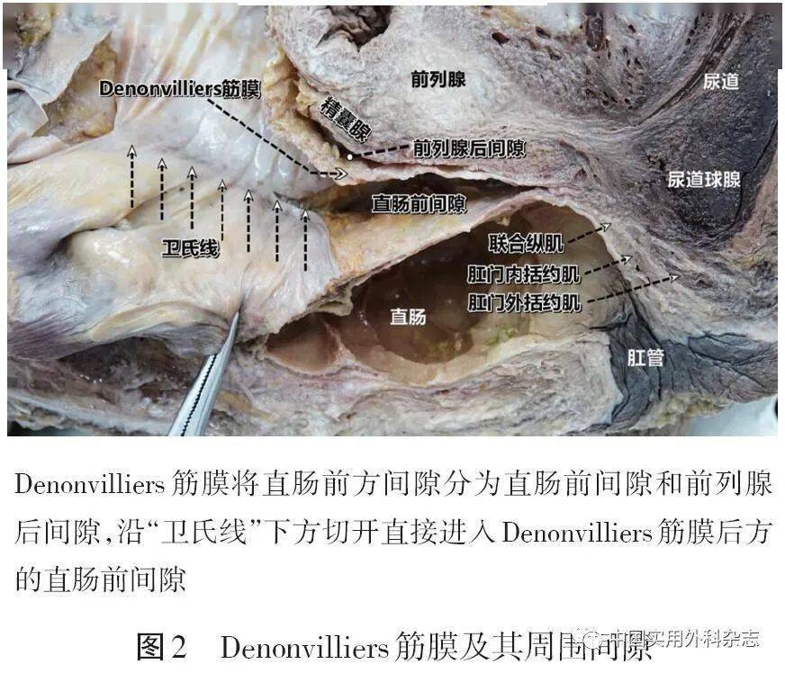 论著盆筋膜解剖及其与直肠固有筋膜关系研究