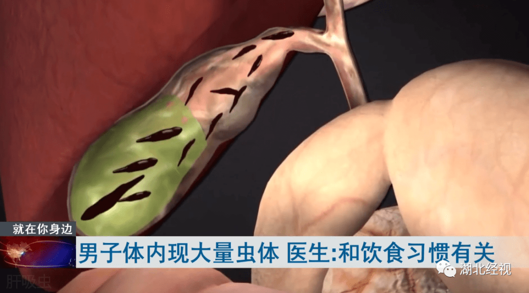 男子|男子体内出现大量活寄生虫！和这种饮食习惯有关