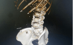 针灸|惊险！广州阿婆自行针灸，针断腹中！医生：擅自针灸有风险