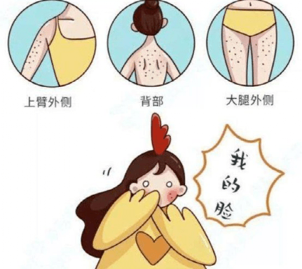 冰点脱毛能去鸡皮肤吗(冰点脱毛能改善鸡皮肤吗)