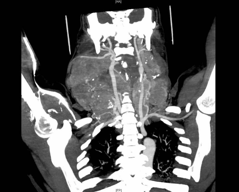 颈部|小肿块“绕颈”生长30年成巨大癌肿，连克难关将其完整切除