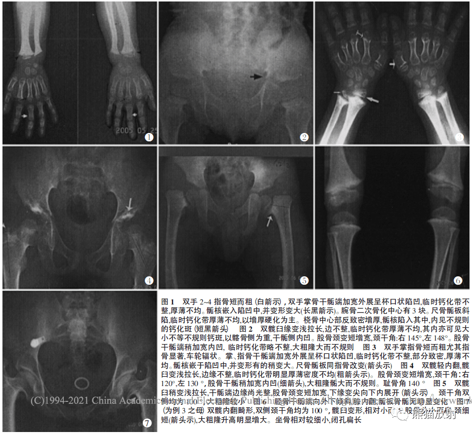 x线诊断要点丨软骨发育不全脊柱骨骺发育不良半肢骨骺发育异常