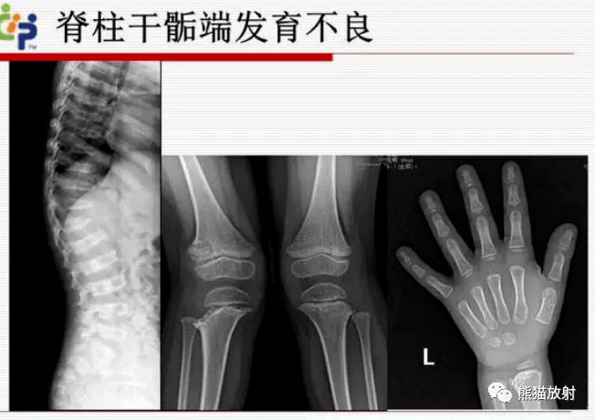 x线诊断要点丨软骨发育不全脊柱骨骺发育不良半肢骨骺发育异常