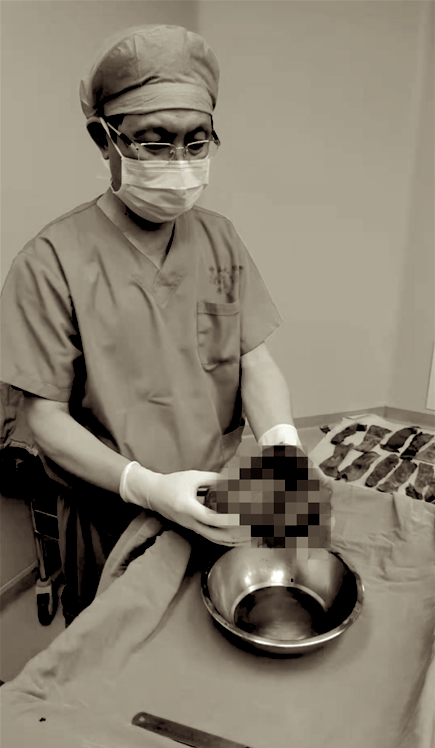 彭俊生|腹膜后硕大肿瘤压迫消化道，摘瘤后顺便治好了顽固性高血压