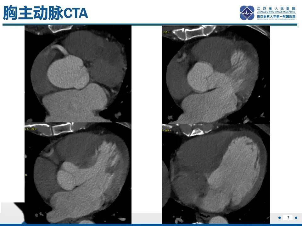 急性st段抬高型心肌梗死_影像