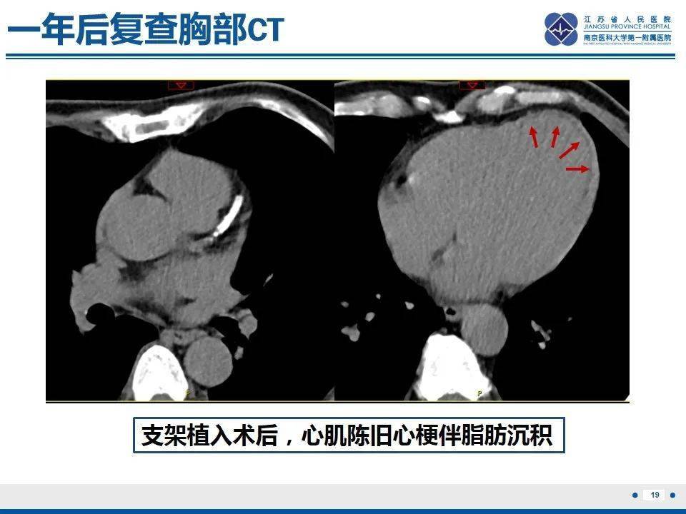 心肌纵断面图片