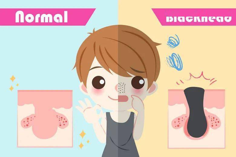 脸上总是长粉刺黑头怎么办祛黑头粉刺最有效方法