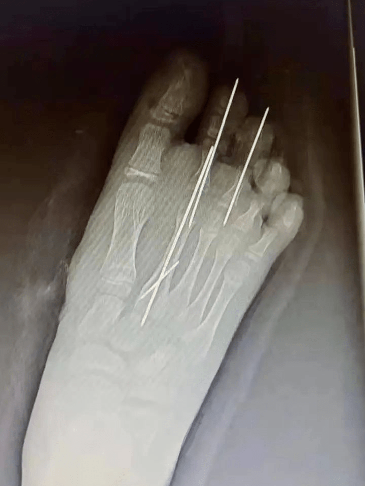 医生为患儿行右第一第二足趾再植及骨折内固定术,辅以石膏外固定