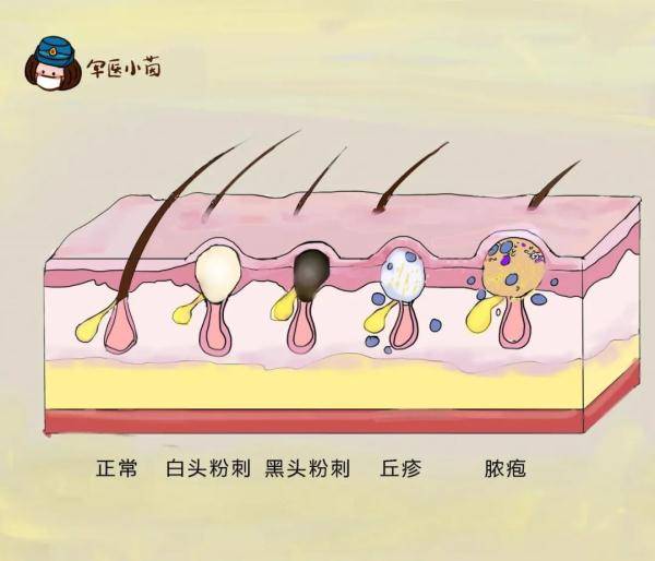 炎症|关于“痘痘”那些不得不说的事