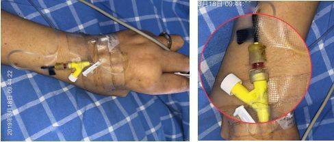 肝素帽内有回血,你说该不该更换?