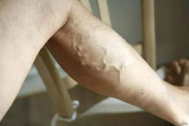 青筋凸起，表示血管毒素淤积？这4个部位凸起，别不当回事…