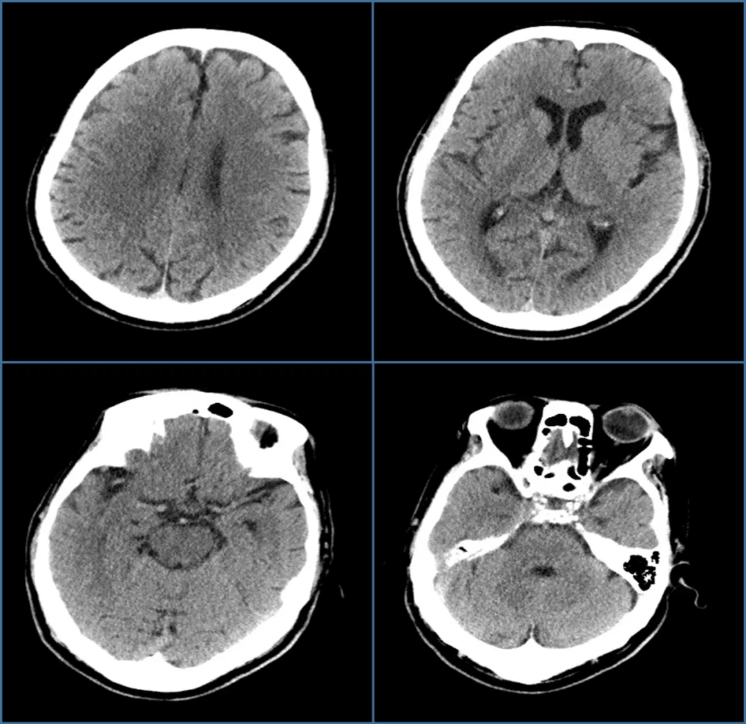 这样的充盈缺损是肺栓塞